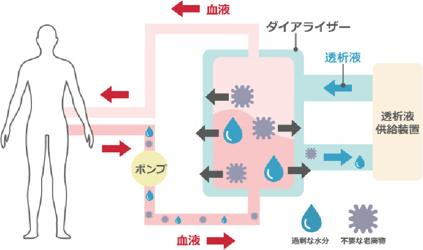 透析のしくみ