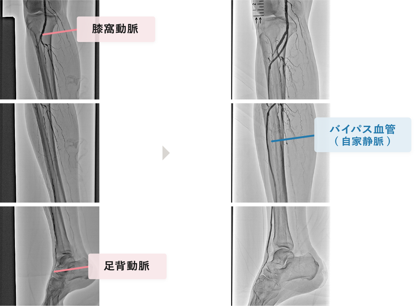 遠位バイパス術